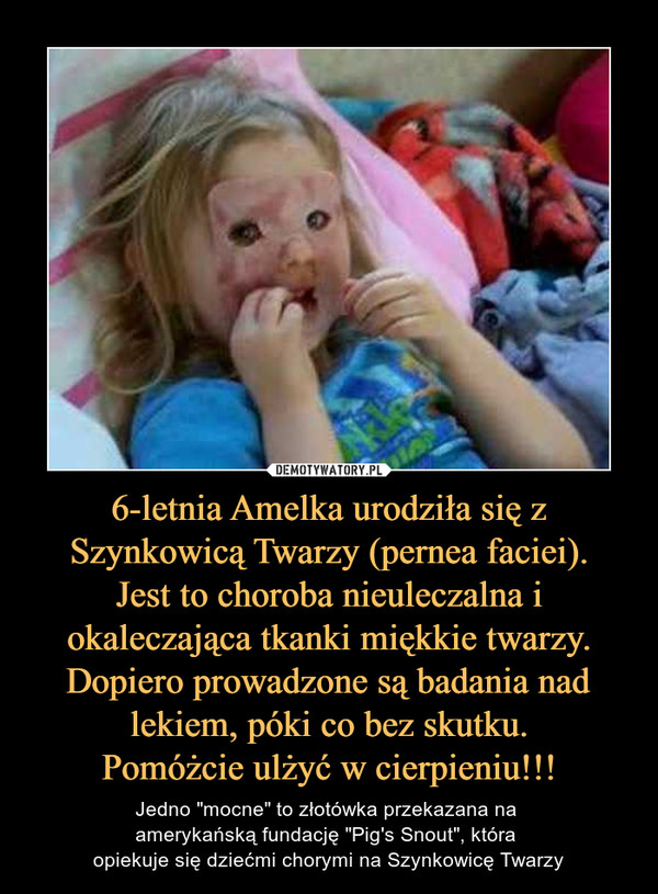 6-letnia Amelka urodziła się z Szynkowicą Twarzy (pernea faciei).
Jest to choroba nieuleczalna i okaleczająca tkanki miękkie twarzy. Dopiero prowadzone są badania nad lekiem, póki co bez skutku.
Pomóżcie ulżyć w cierpieniu!!!