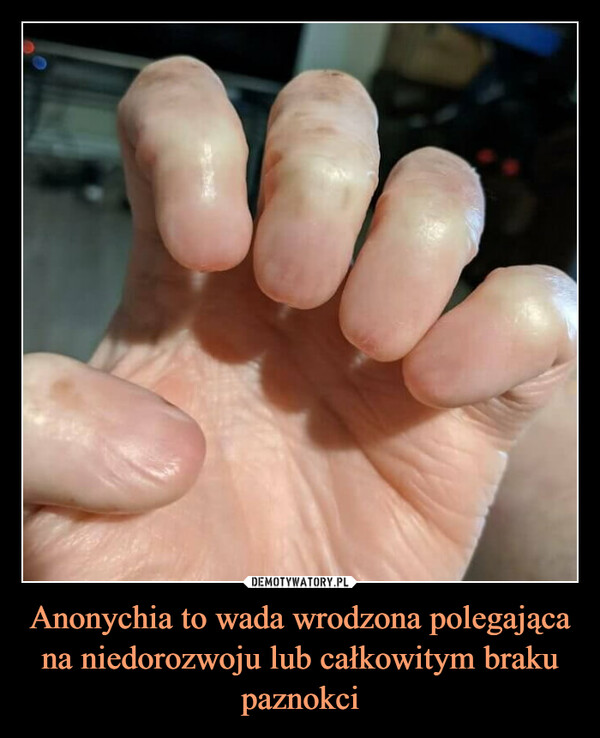 Anonychia to wada wrodzona polegająca na niedorozwoju lub całkowitym braku paznokci